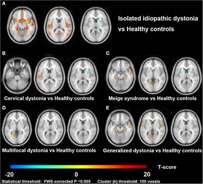 Imaging Insights of Isolated Idiopathic Dystonia: Voxel-Based Morphometry and Activation Likelihood Estimation Studies